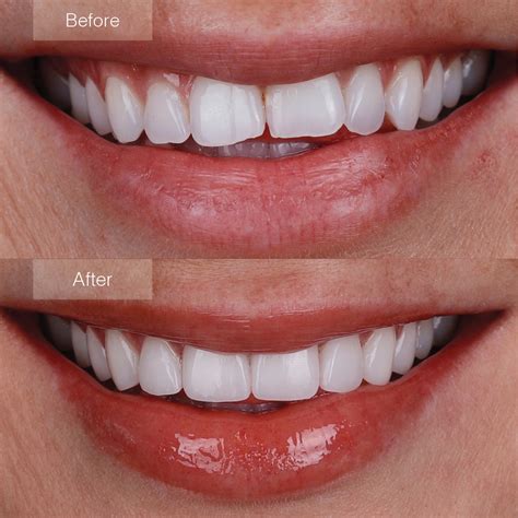 Dental Veneers .